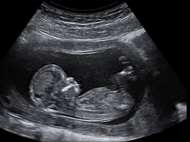 Inside Our Embryo Transfer and First Trimester